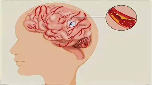 脑梗发作前三大征兆揭秘，身体这三个部位悄悄变硬，你发现了吗？警惕生命危机前的无声警报！娱乐生活与健康同行。